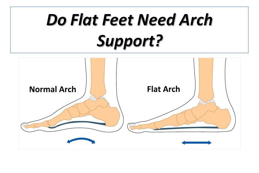 Do Flat Feet Need Arch Support?